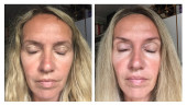 before-after2wks-mette
