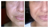 before-after3wks-alba