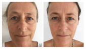 before-after6wks-pernille